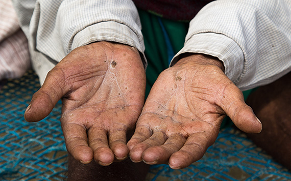 Arsenic poisoning, hands